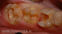 odbudowa zęba trzonowego