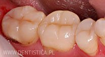 ubytek zęba przed leczeniem